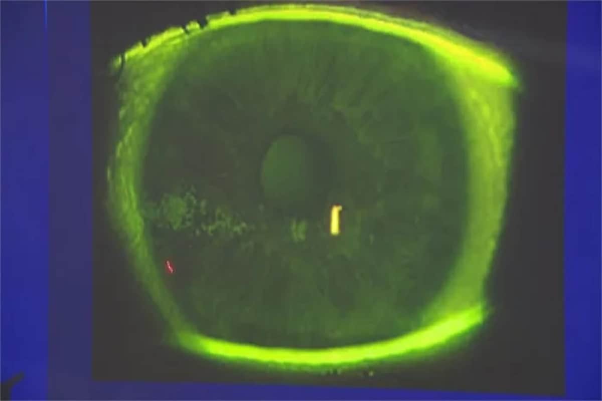 Never use smartphone with full brightness this woman has 500 holes in eye