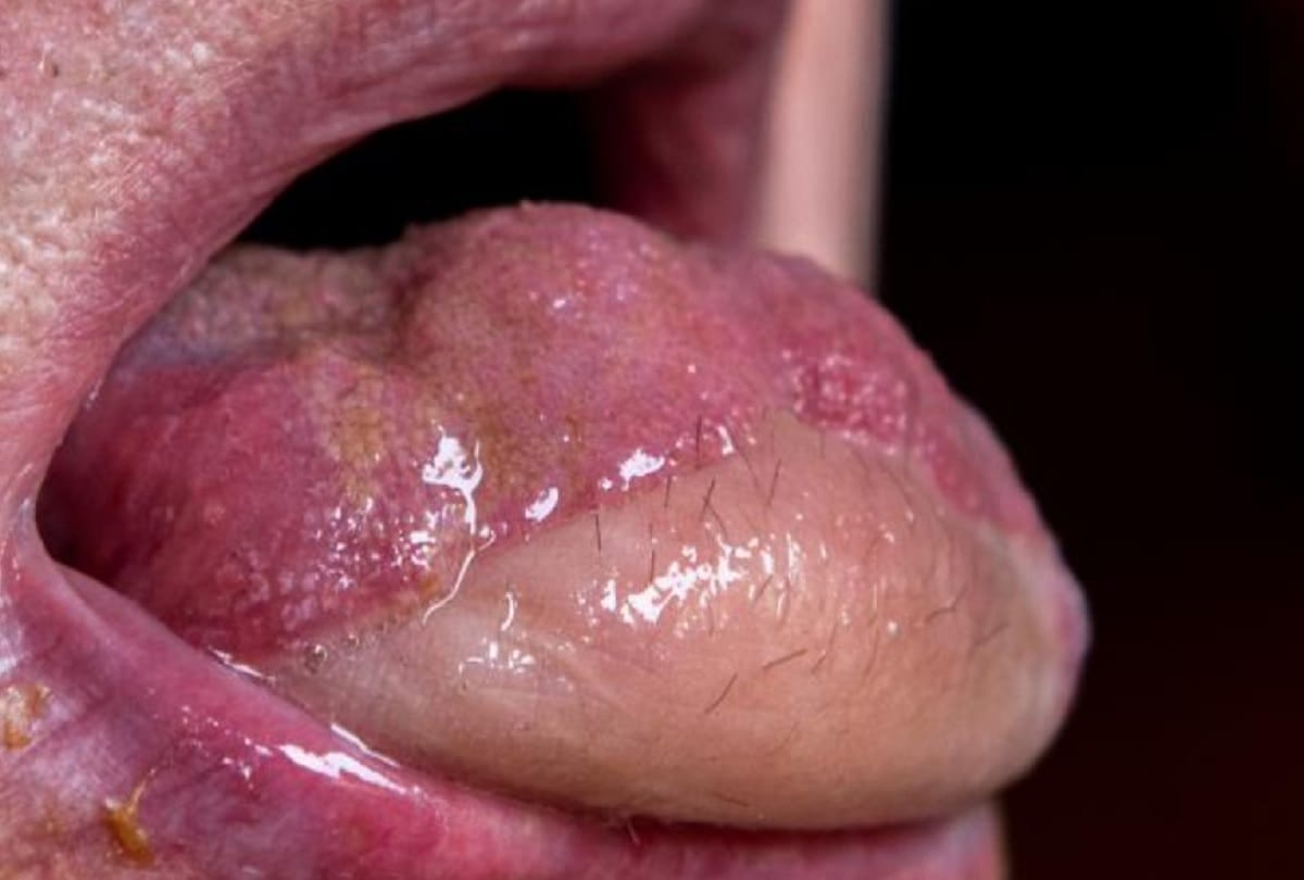 Cancer survivor melvyn mansell told shocking story of his hairy tongue