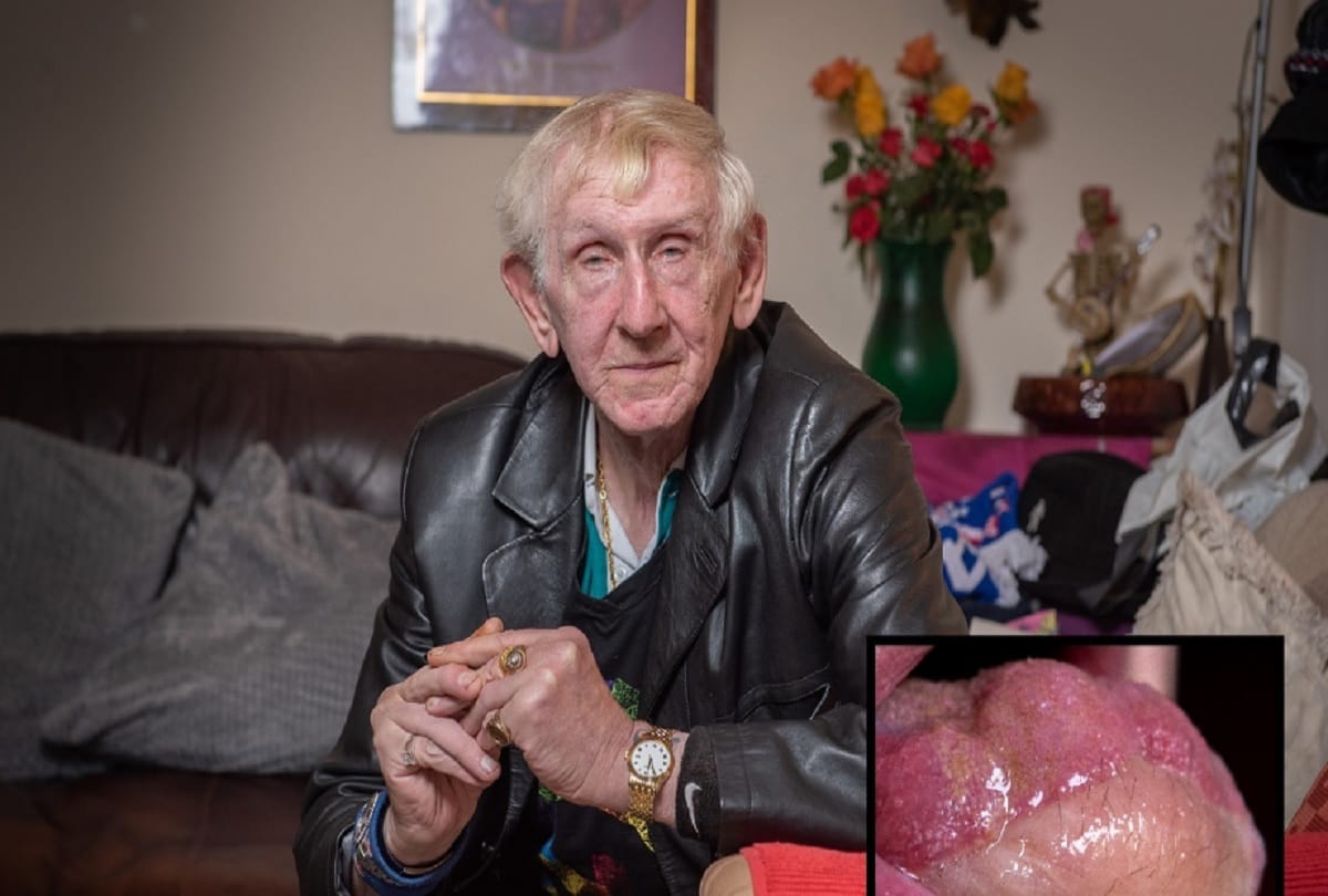Cancer survivor melvyn mansell told shocking story of his hairy tongue