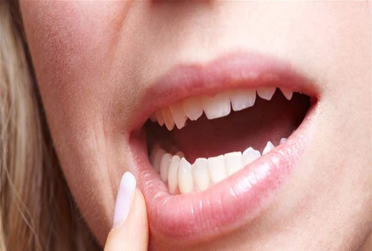 mouth ulcers treatment medicine