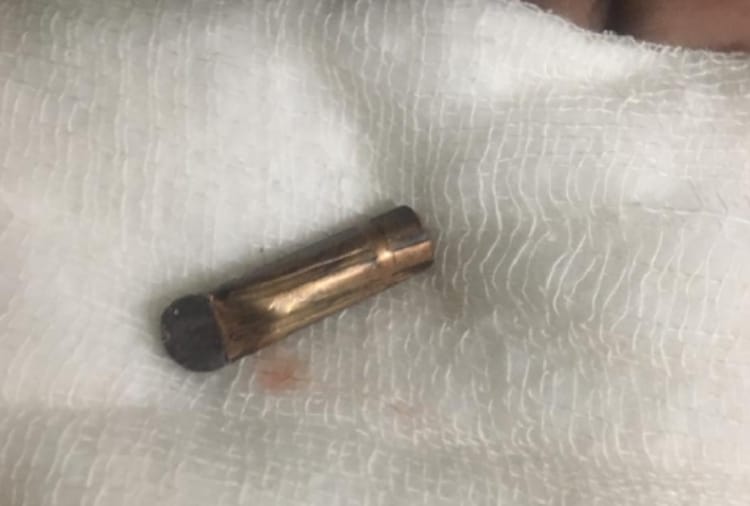 Woman injured by bullet in Batala of Punjab