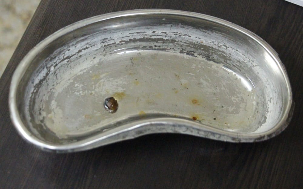 eye operation in doon hospital doctor found Parasite