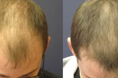 हेयर ट्रांसप्लांट (फाइल फोटो)