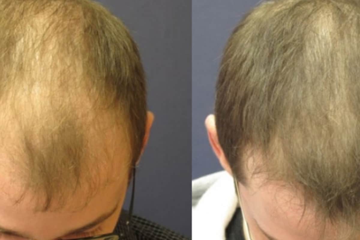 businessman died in hospital after underwent a 12 hourlong hair transplantation procedure