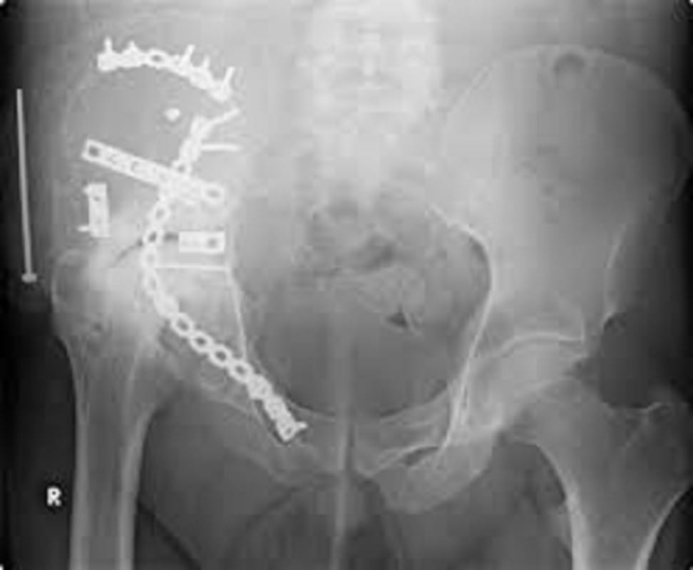 orthopedic implants factories running without license, CDSCO raid in four states