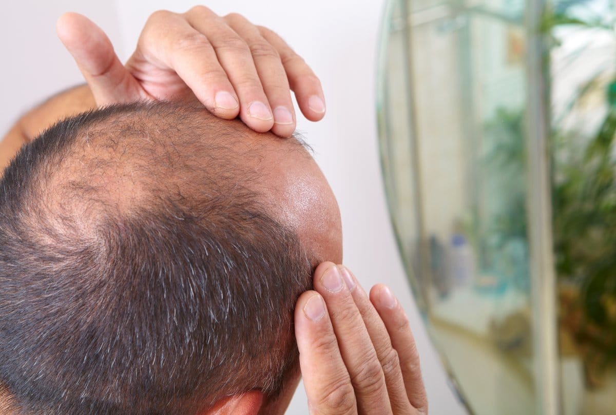 due to harmonal effect men go bald