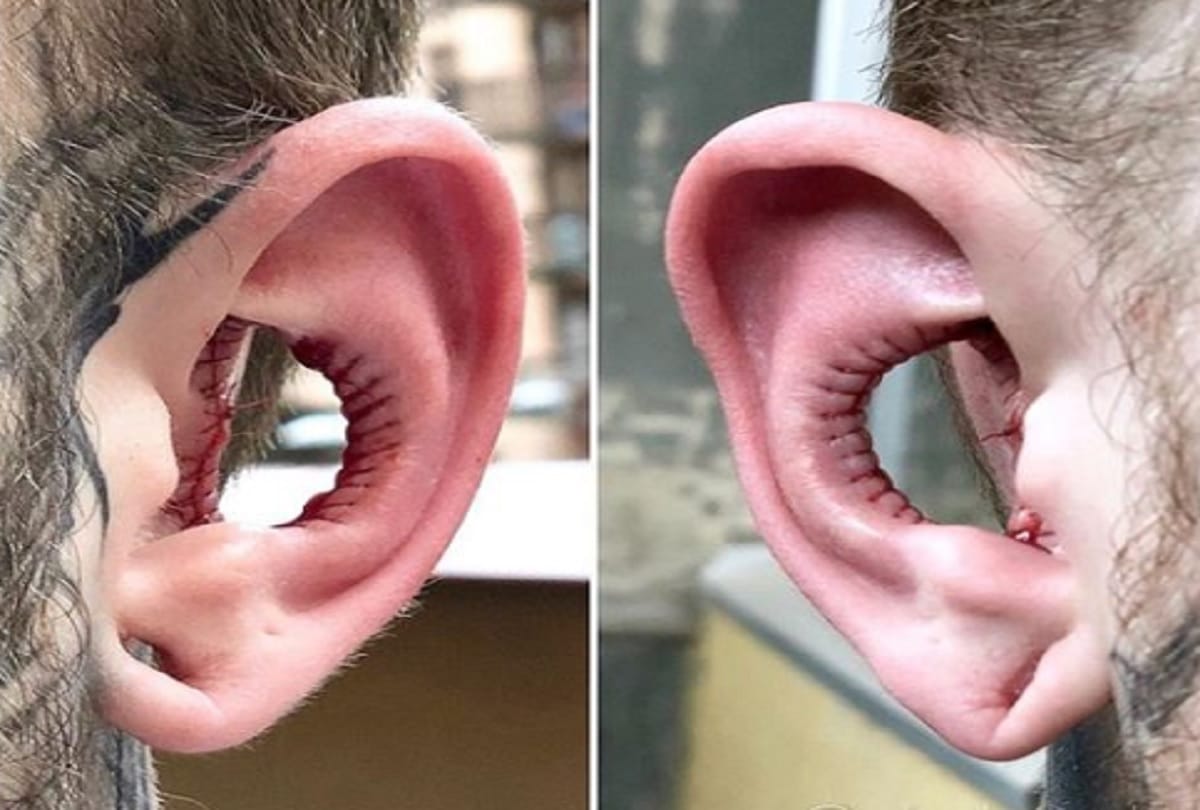 body modification enthusiast has part of ear removed in controversial procedure