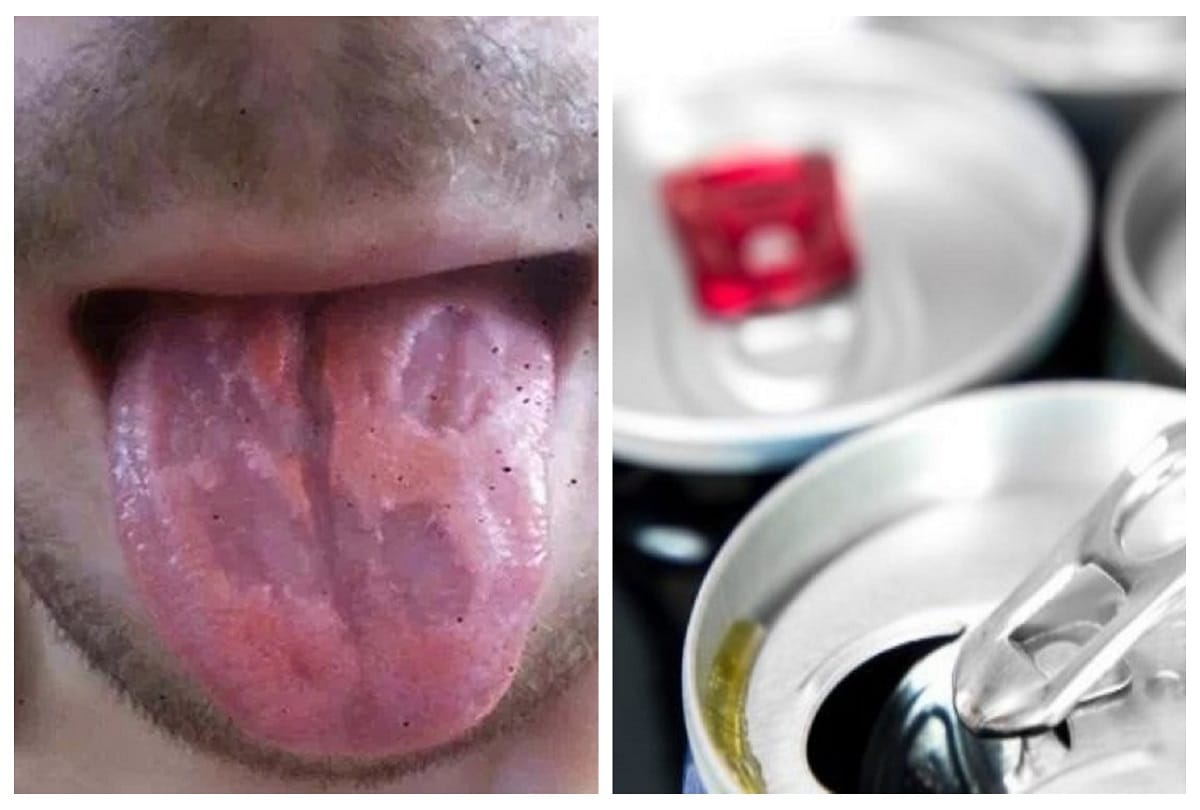 Teacher Shares Photo Of Tongue use to drink 5 to 6 energy drink cans per day  