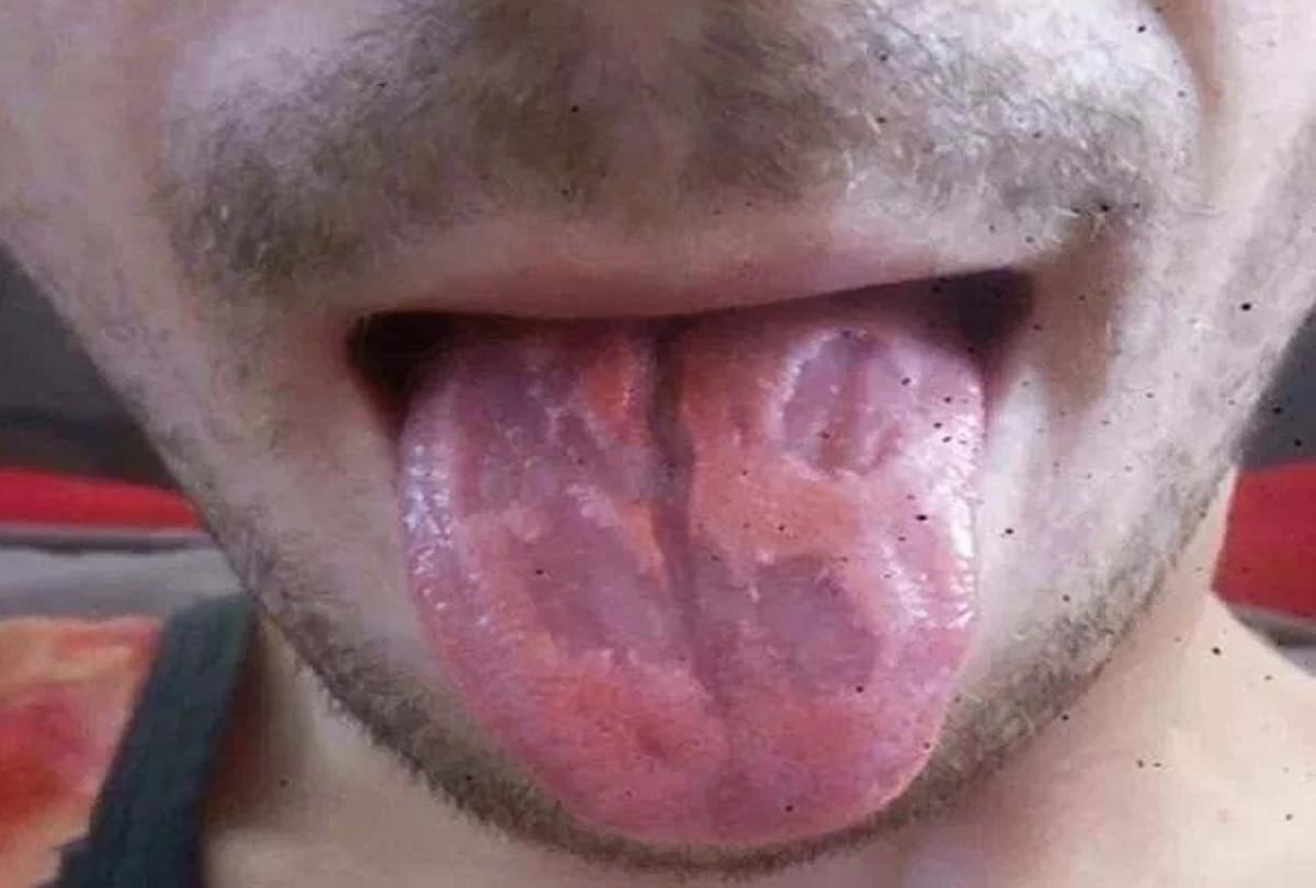 Teacher Shares Photo Of Tongue use to drink 5 to 6 energy drink cans per day  