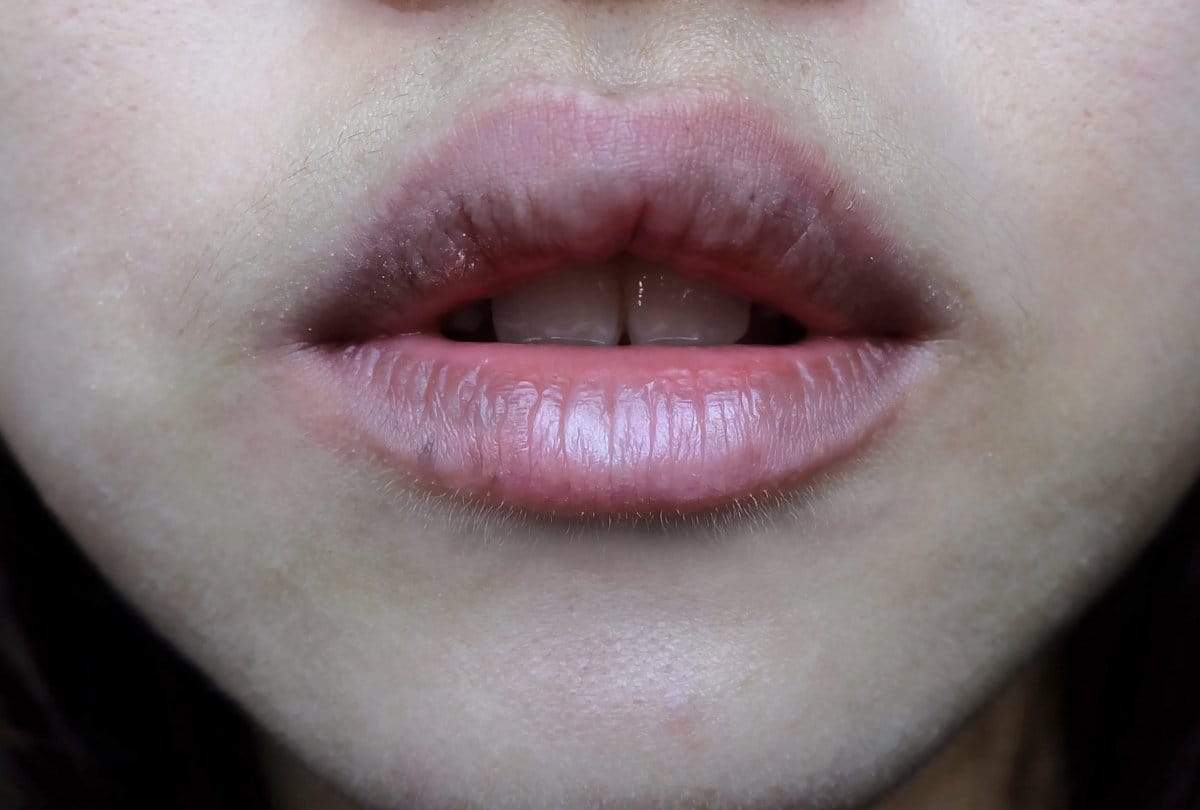 dehydration symptoms and treatment
