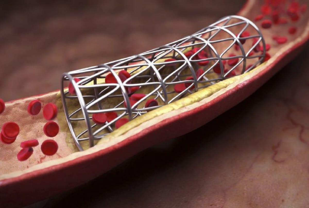 Stent cost increase Rs 2000 from today by NPPA