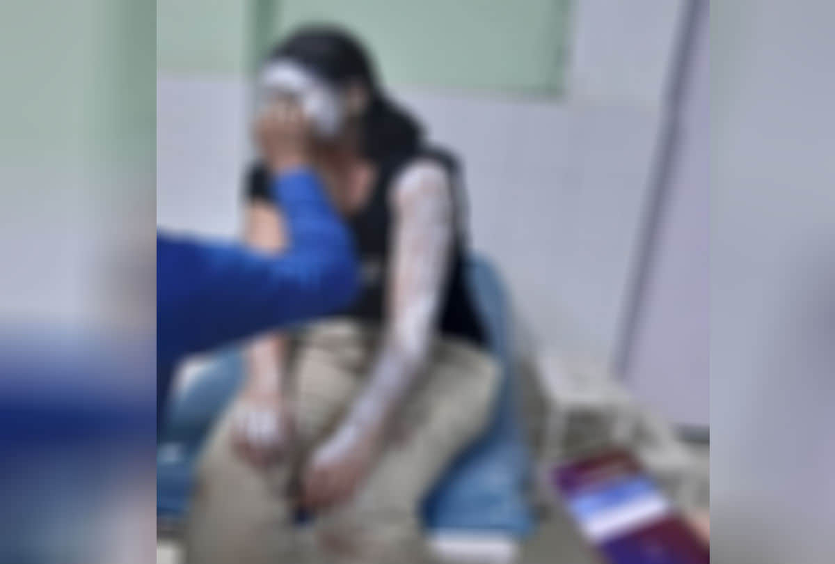 Up women police constable injured in acid attack in Mathura