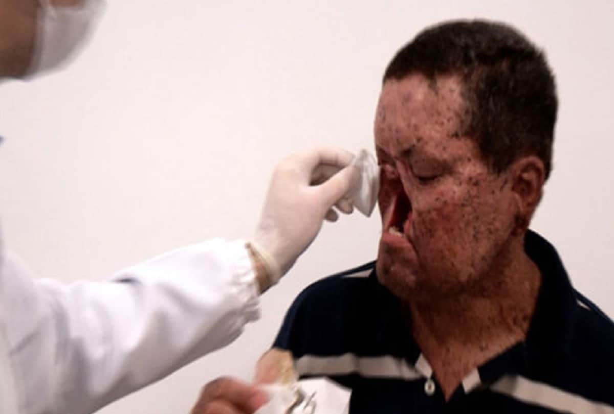 Brazil village Araras where people melt away under the sun due to Xeroderma Pigmentosa