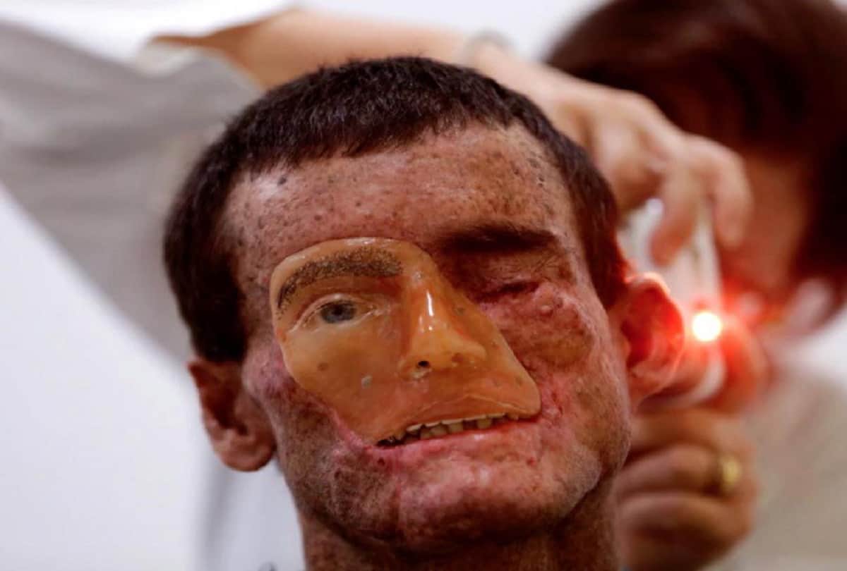 Brazil village Araras where people melt away under the sun due to Xeroderma Pigmentosa