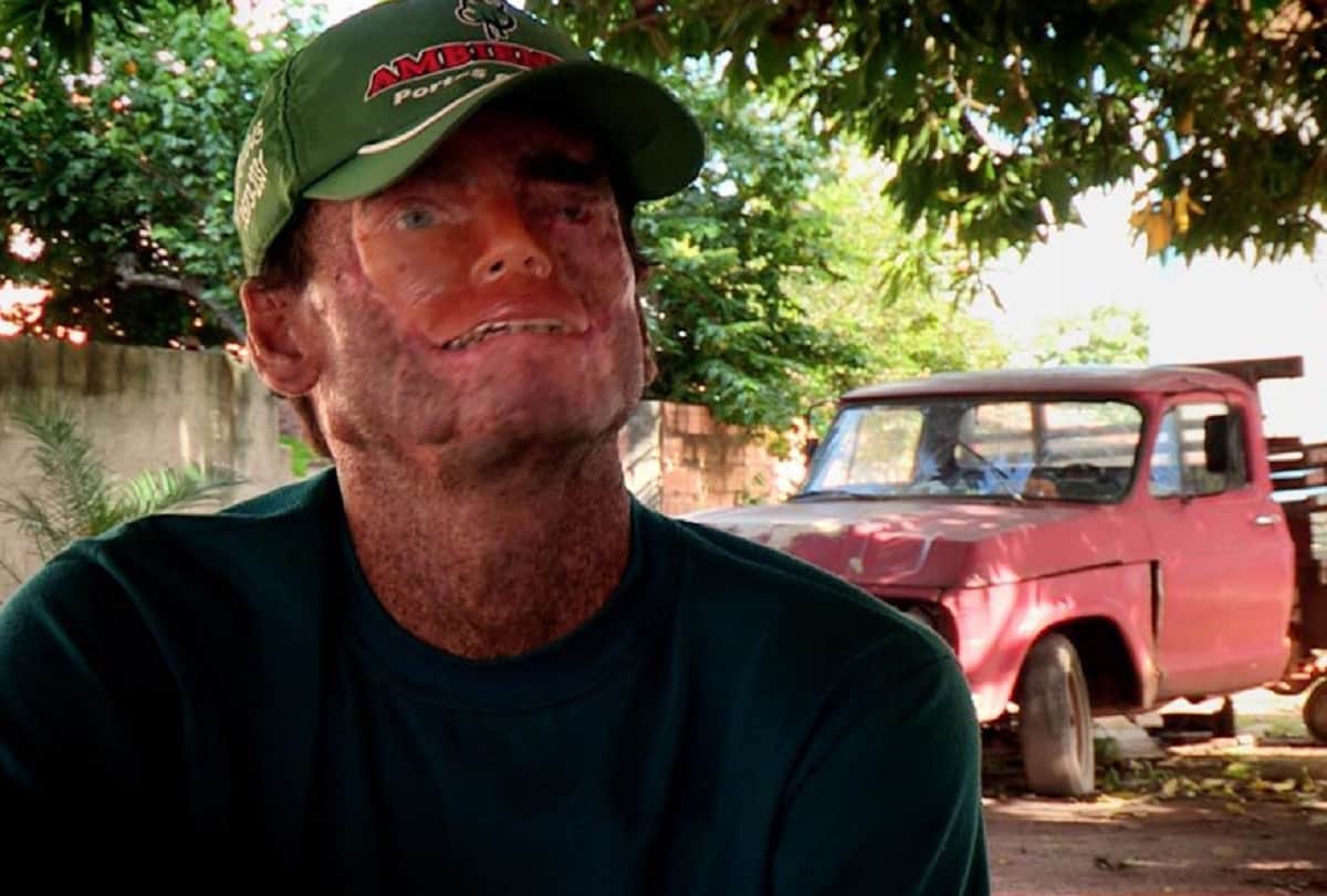 Brazil village Araras where people melt away under the sun due to Xeroderma Pigmentosa