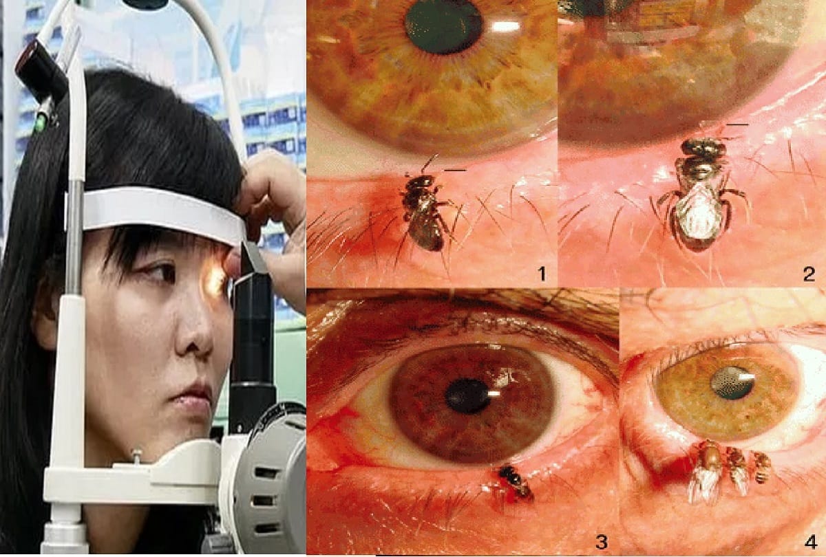 Doctors find live four bees inside woman’s EYE where they were drinking her tears