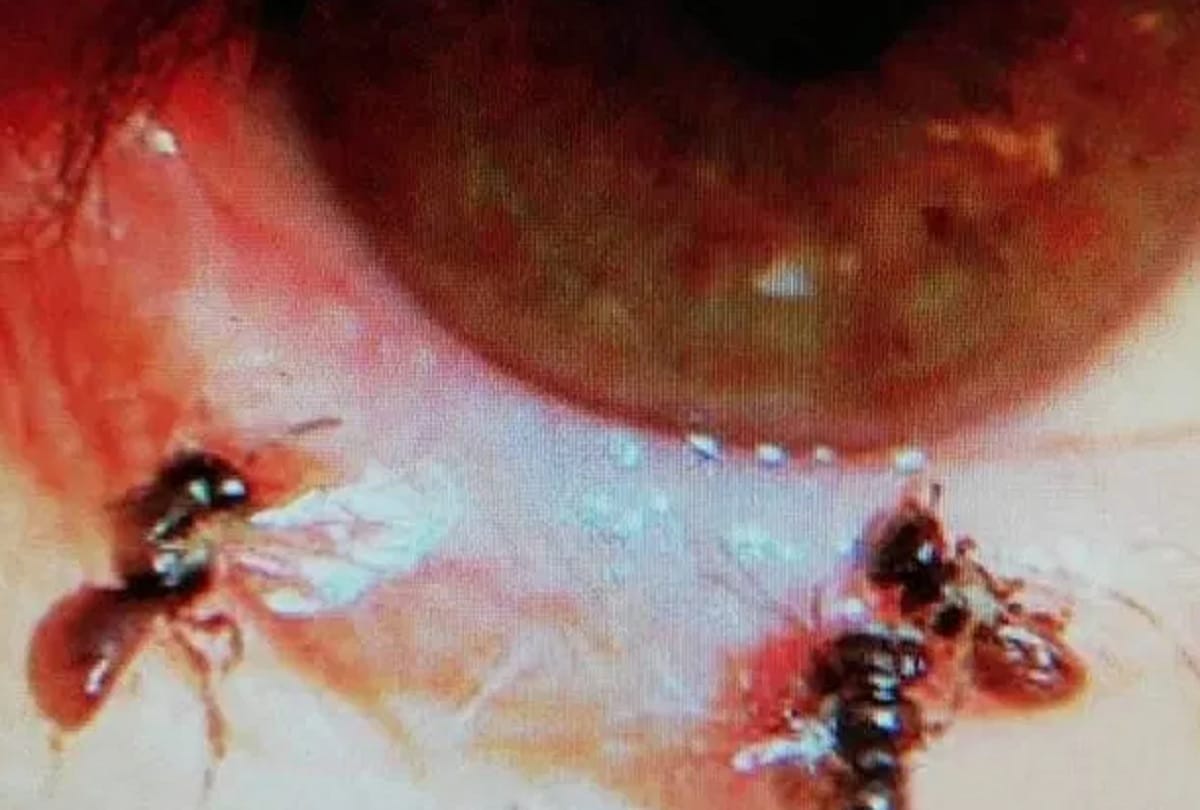 Doctors find live four bees inside woman’s EYE where they were drinking her tears