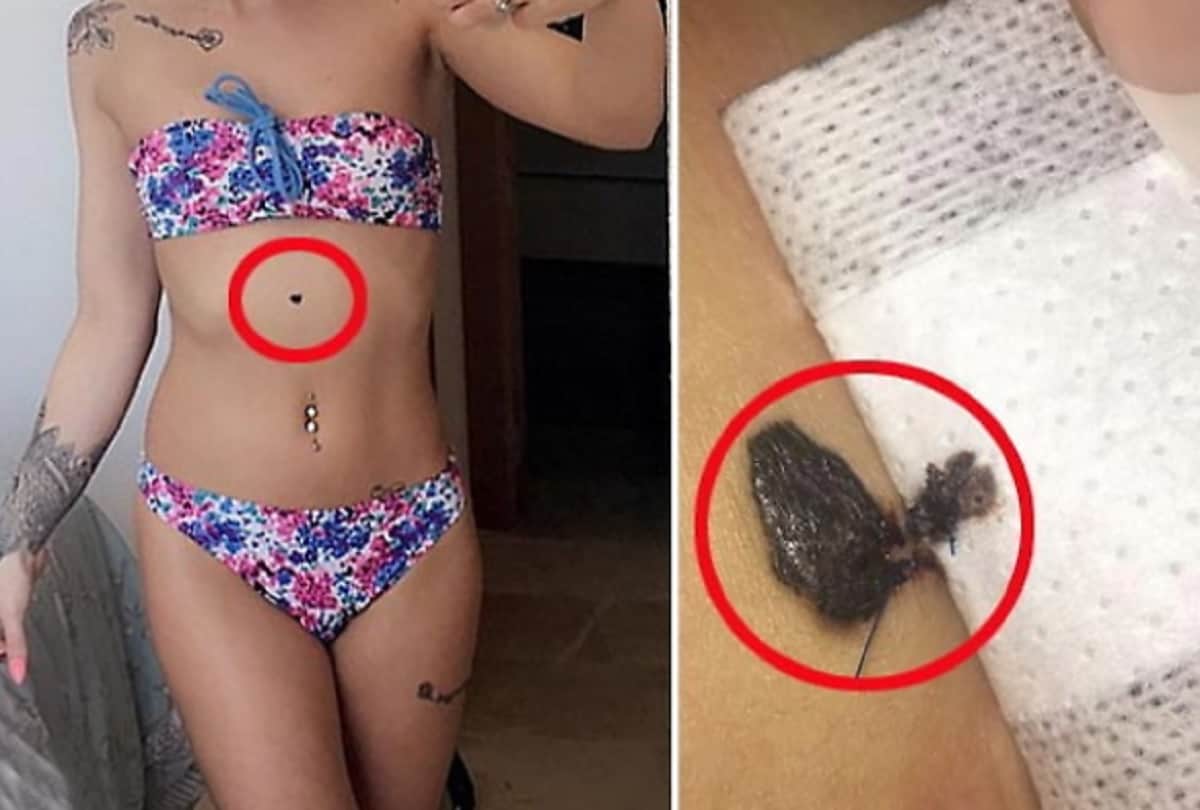 Wolverhampton model bikini girls Chloe Jordan selfie saved her life revealed She had skin cancer