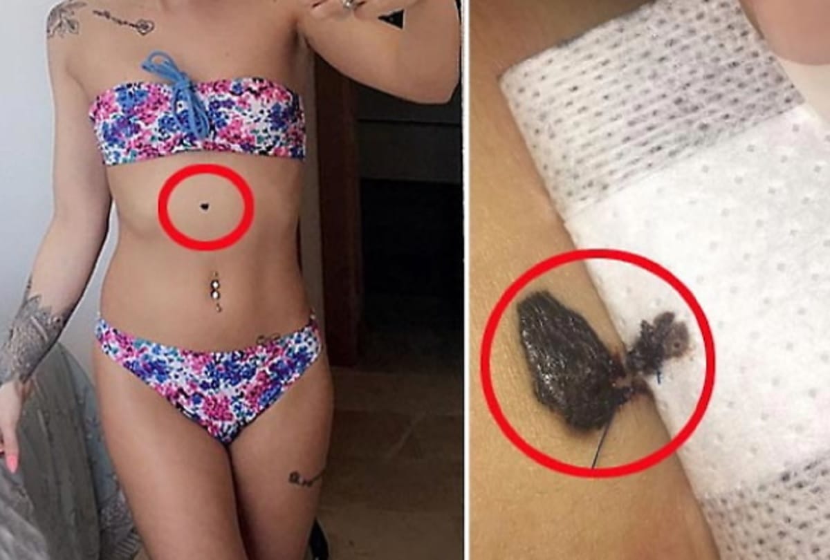 Wolverhampton model bikini girls Chloe Jordan selfie saved her life revealed She had skin cancer