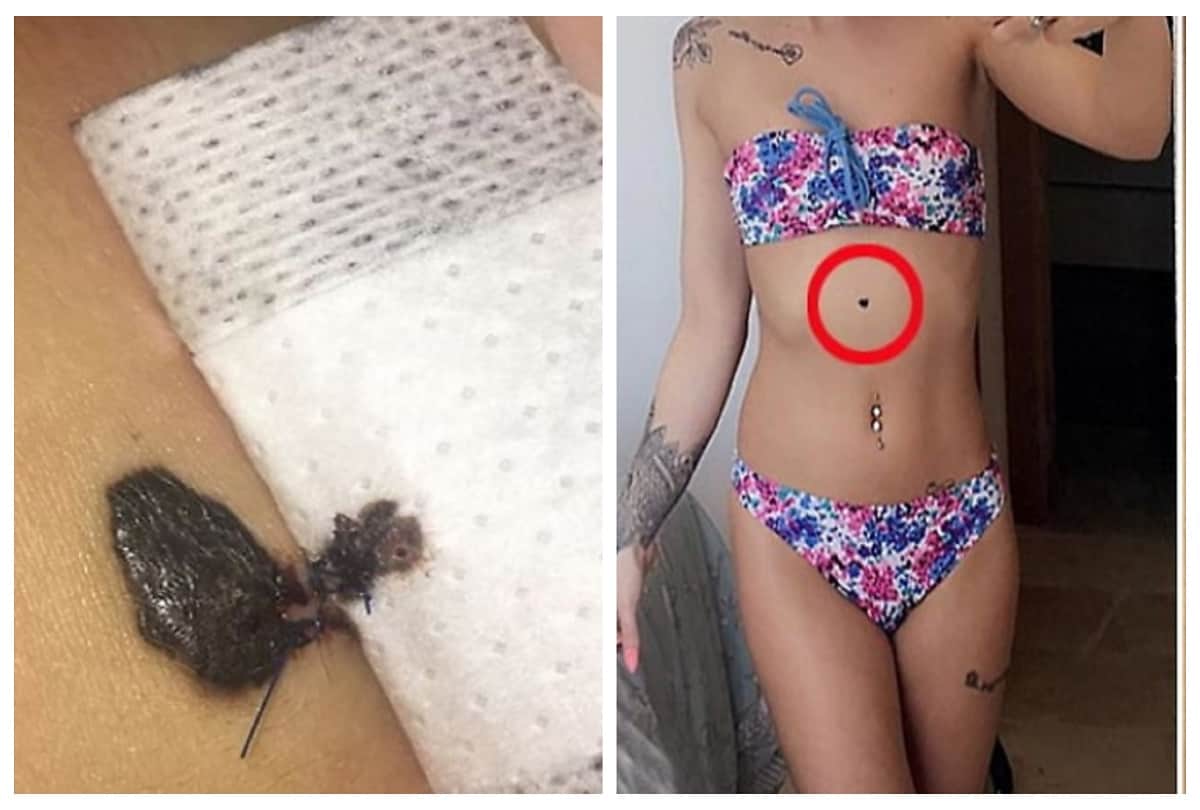 Wolverhampton model bikini girls Chloe Jordan selfie saved her life revealed She had skin cancer
