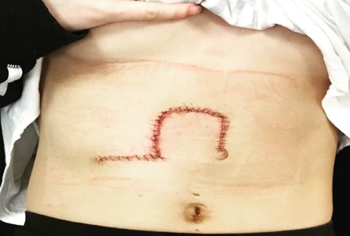 Wolverhampton model bikini girls Chloe Jordan selfie saved her life revealed She had skin cancer