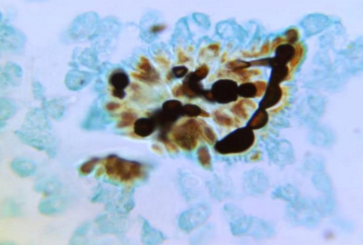 Mystery Fungus Candida Auris infection widely spread around the world Panic In Medical World