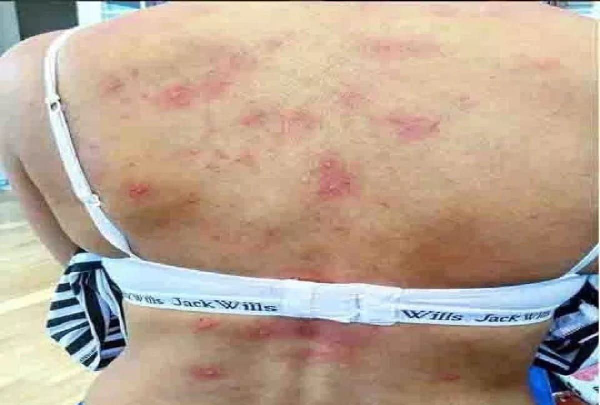 Young mother developed rare water allergy after giving birth