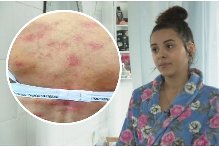 Young Mother Developed Rare Water Allergy After Giving Birth Amar