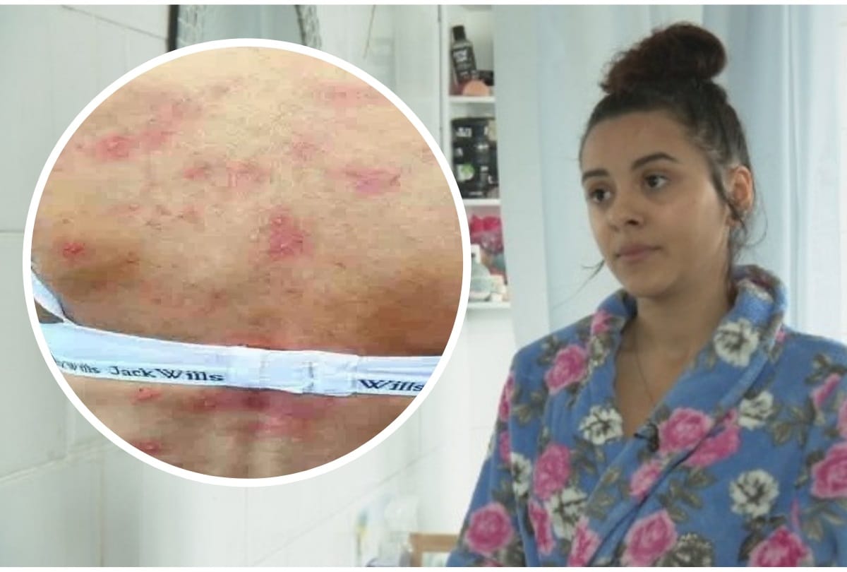 Young mother developed rare water allergy after giving birth