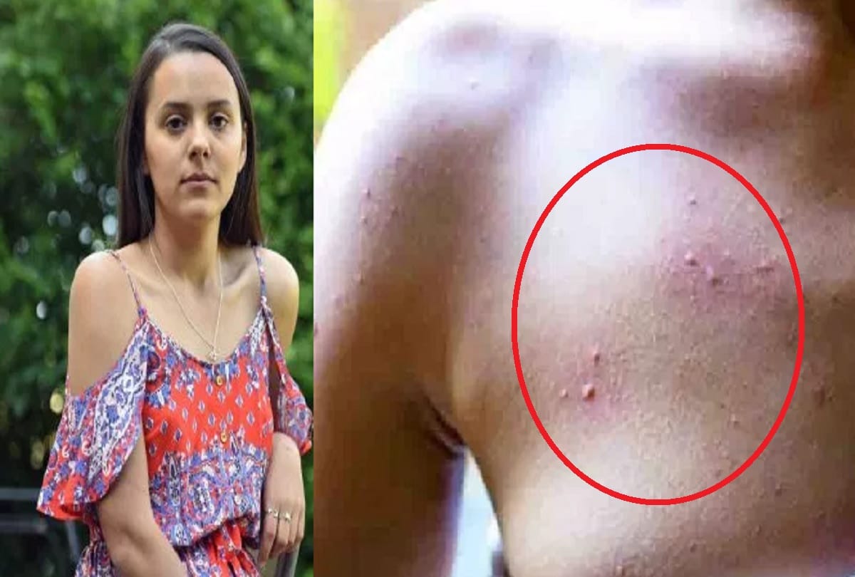 Young mother developed rare water allergy after giving birth