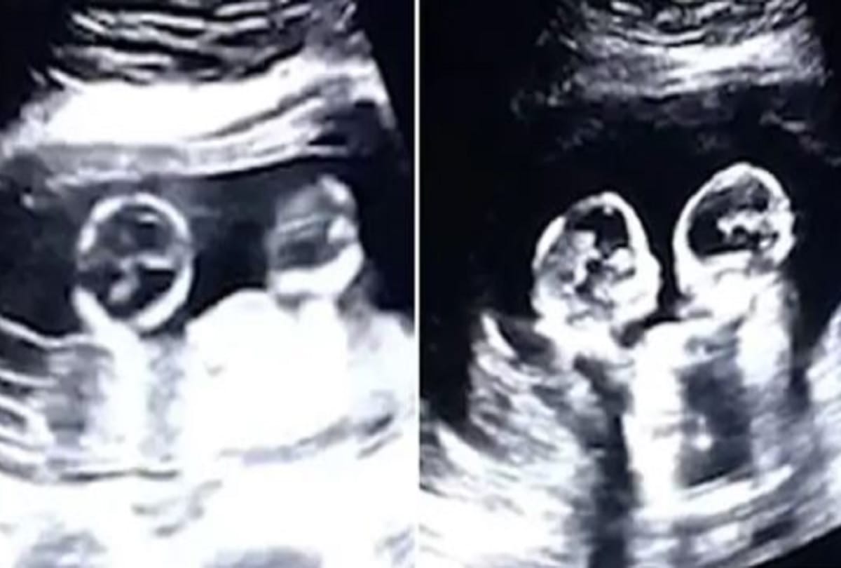 twins spotted fighting inside mother womb during ultrasound Video goes Viral 
