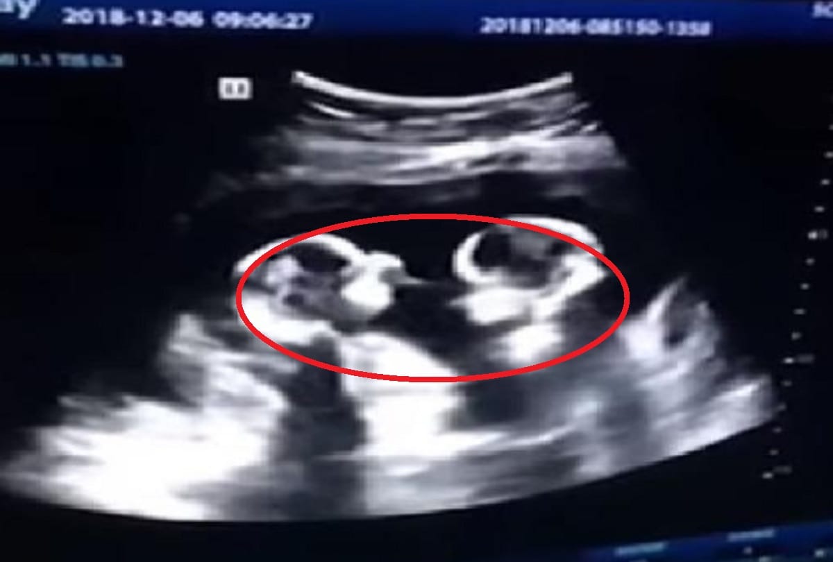 twins spotted fighting inside mother womb during ultrasound Video goes Viral 