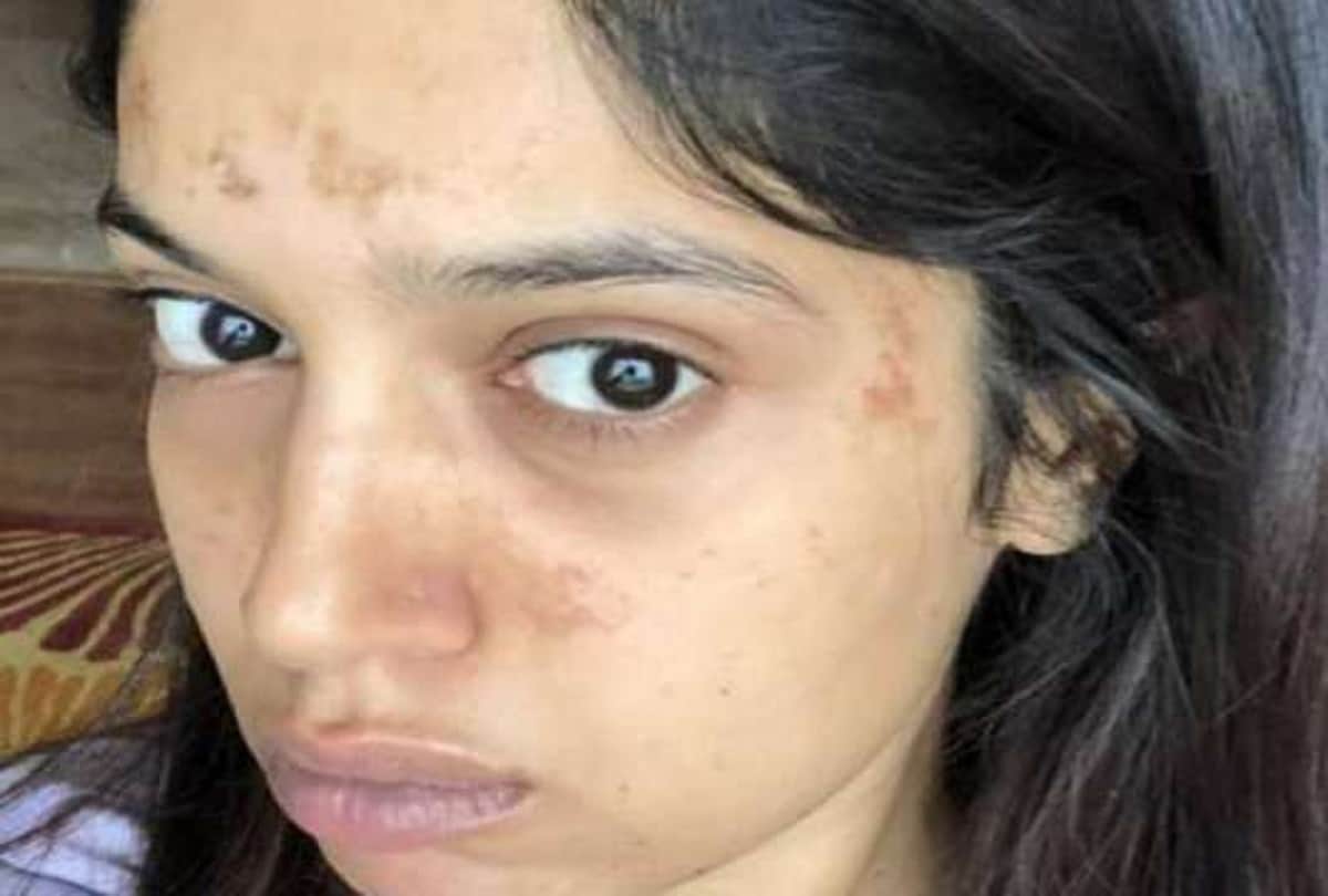 bhumi pednekar face fire during saand ki aankh shooting