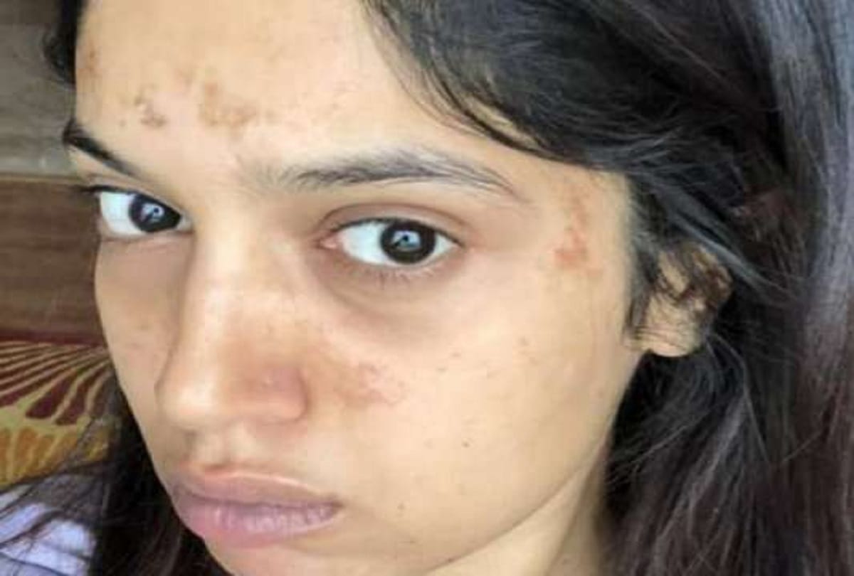bhumi pednekar face fire during saand ki aankh shooting