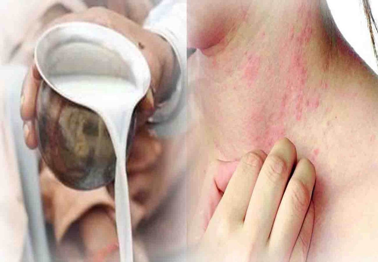 Bruceella's disease like TB from drinking milk of cow and buffalo