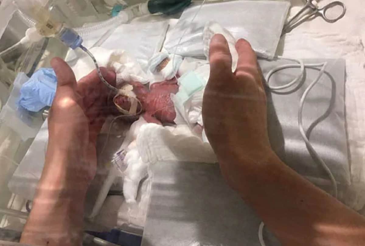 worlds smallest Japanese baby boy broke record for being born the size of an apple