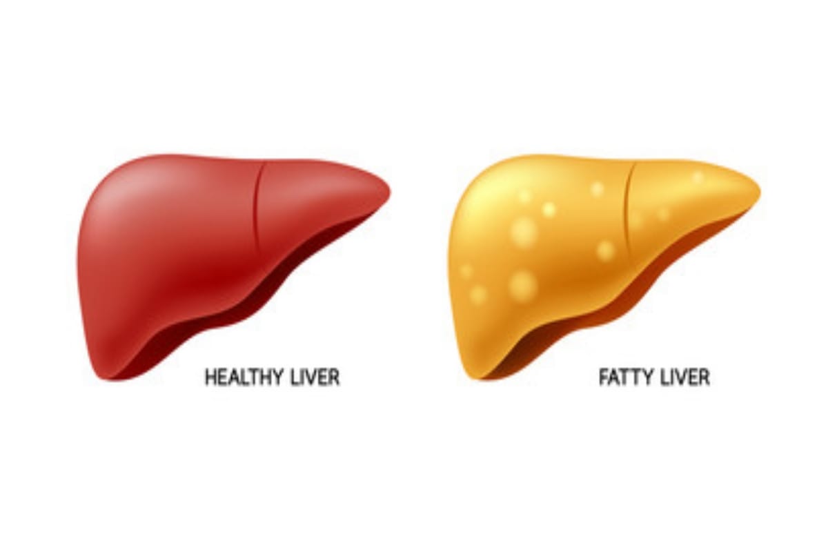 world liver day 2019 know fatty liver disease symptoms causes and treatment