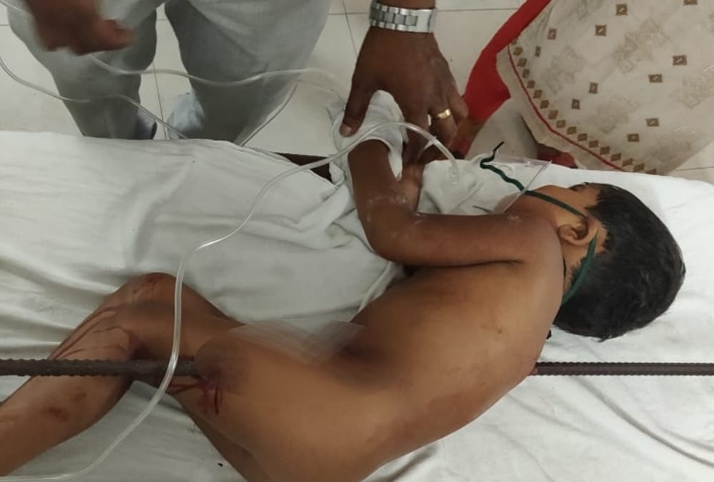 doctors removed iron rod from child's stomach in kgmu