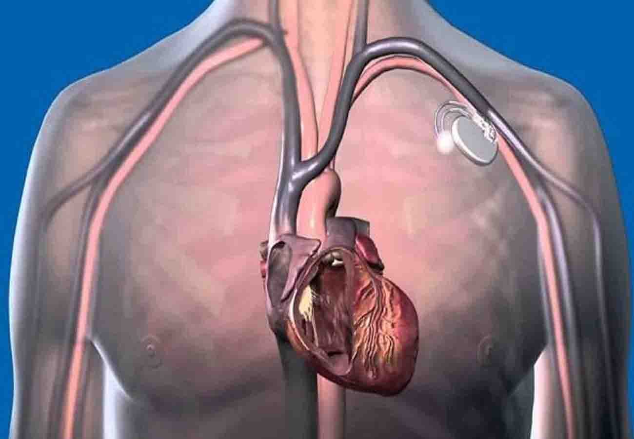 World's smallest pacemaker planted in heart patient