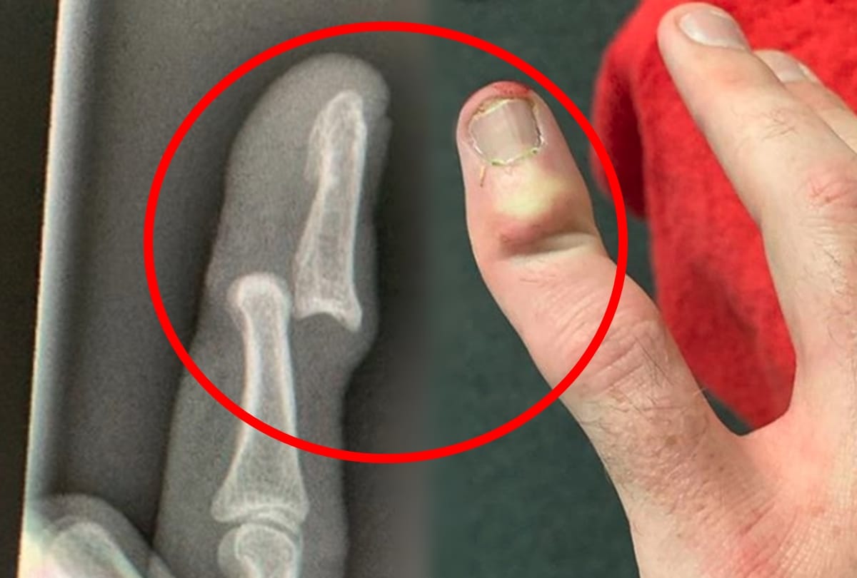 Surrey’s Rikki Clarke suffers a terrible finger injury