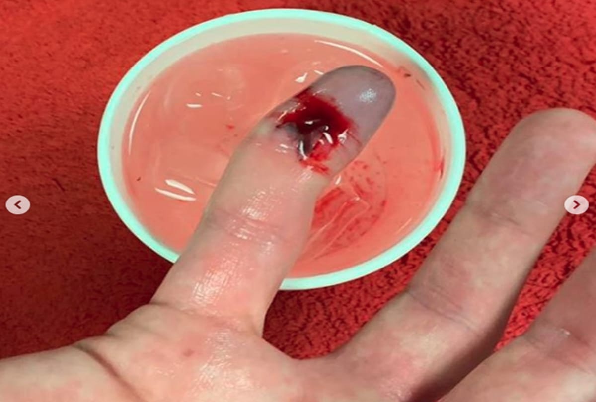 Surrey’s Rikki Clarke suffers a terrible finger injury