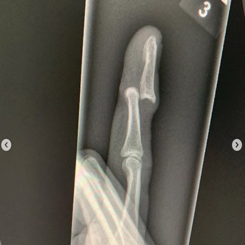 Surrey’s Rikki Clarke suffers a terrible finger injury