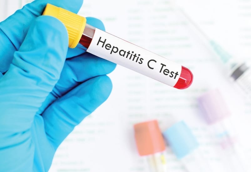 Treatment of 4000 Hepatitis C Stains