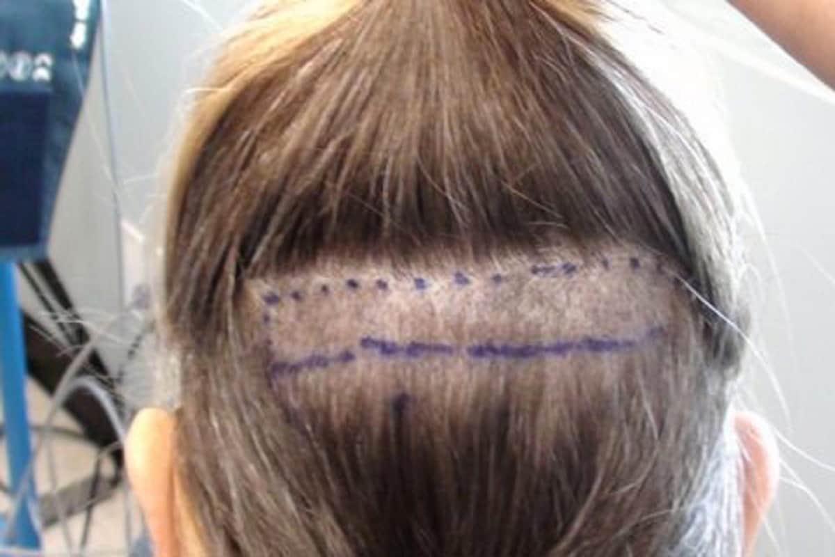 Women looses hair after hair transplant, consumer foram order clinic to give compensation