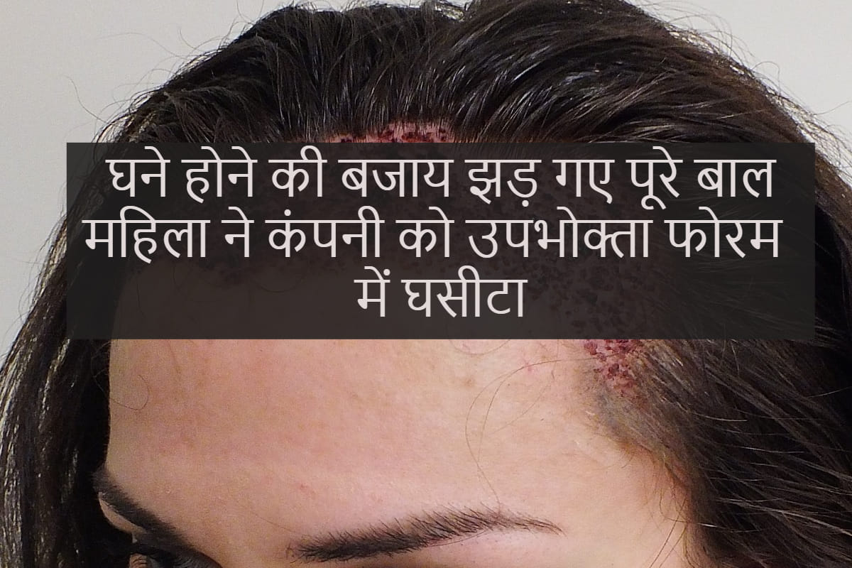 Women looses hair after hair transplant, consumer foram order clinic to give compensation