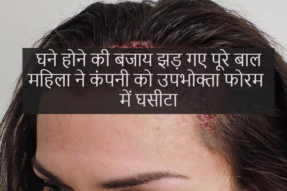 Women looses hair after hair transplant, consumer foram order clinic to give compensation