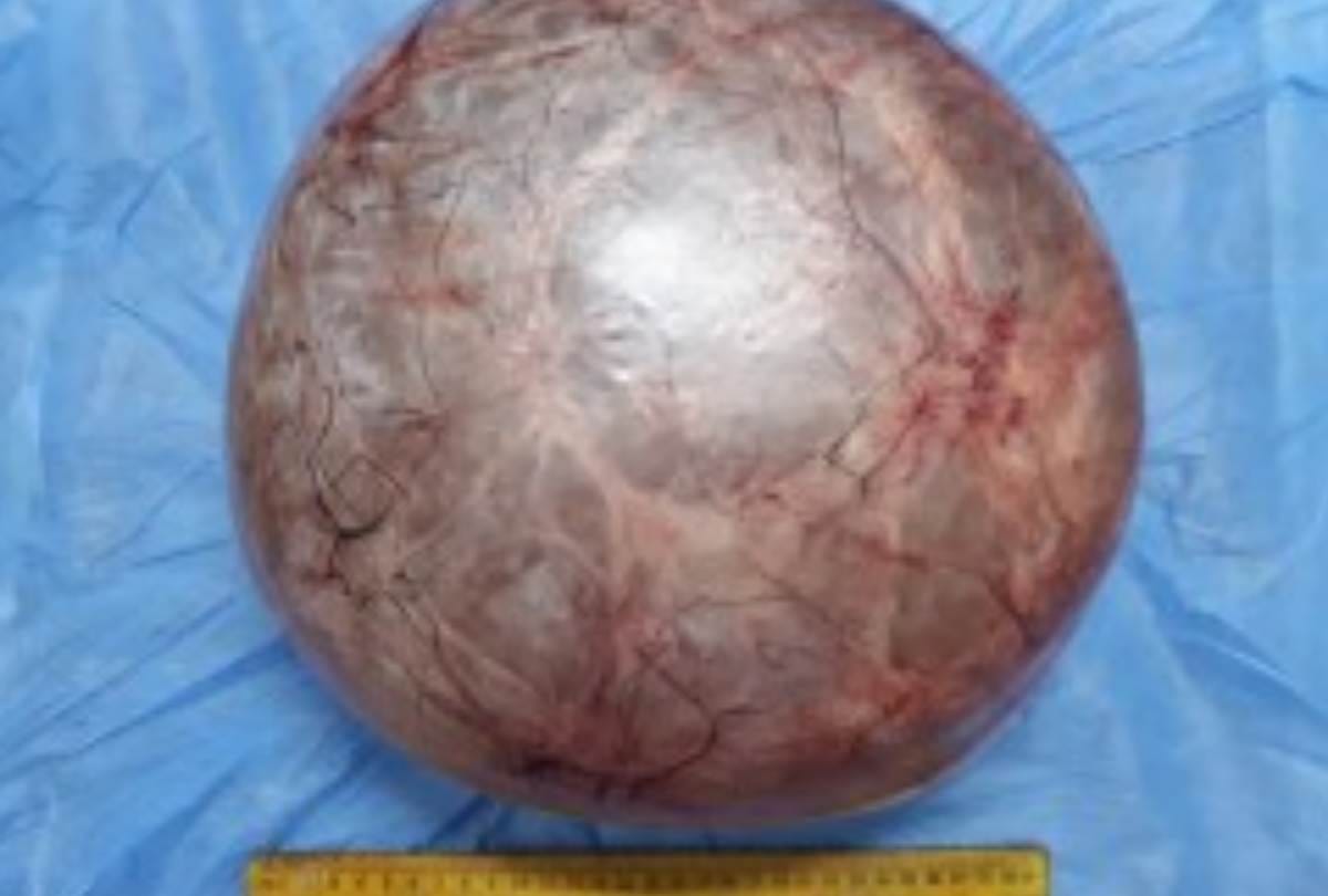 doctors removed 11.5 kg tumor from woman's stomach