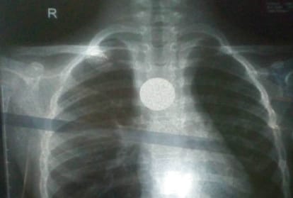 doctors removed coin from child's alimentary canal