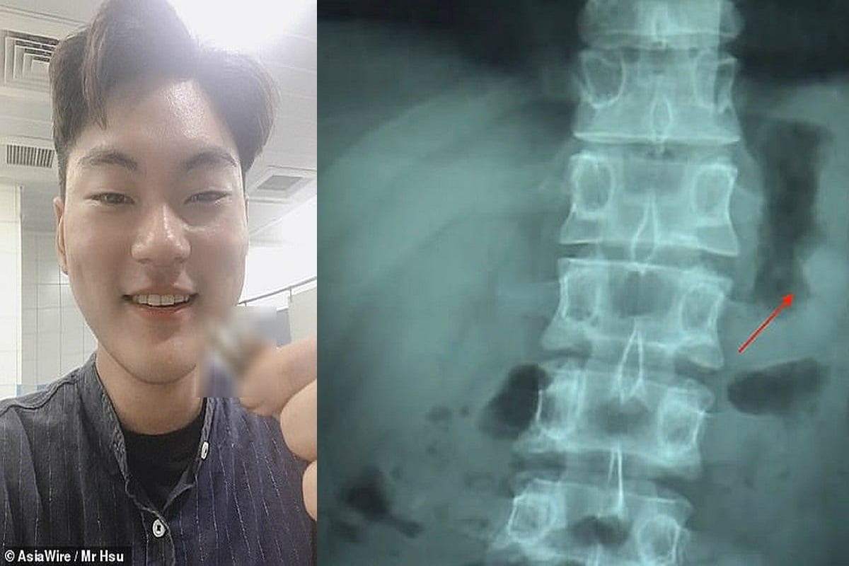 Taiwanese Man swallows AirPod
