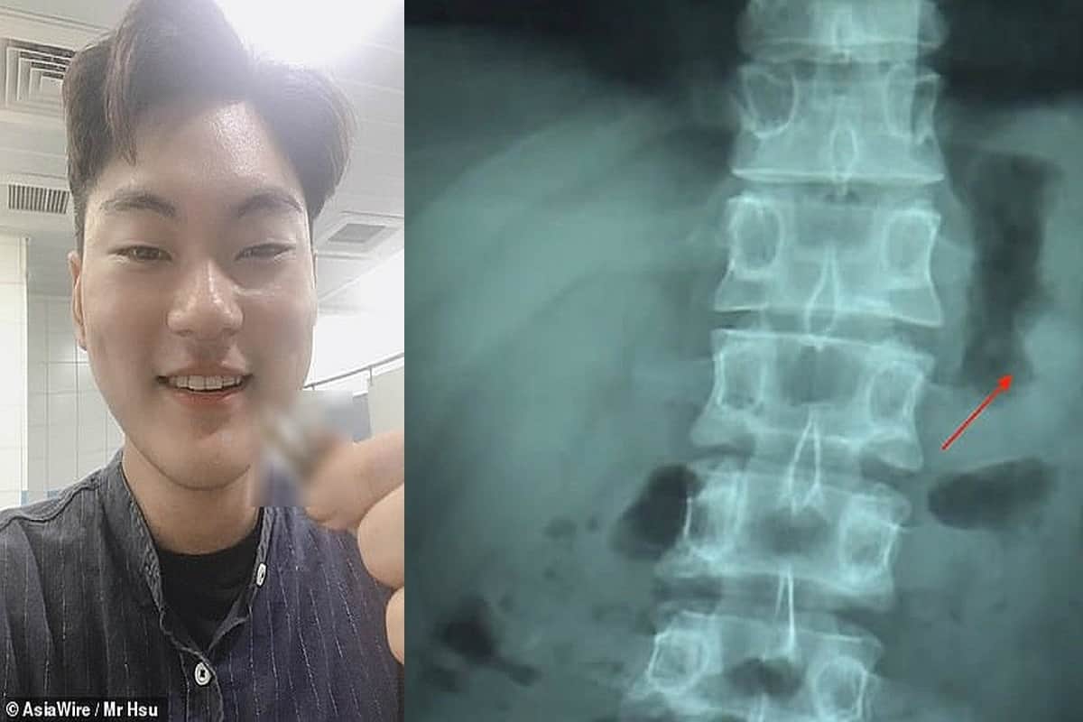 Taiwanese Man swallows AirPod while sleeping and poops it out next day